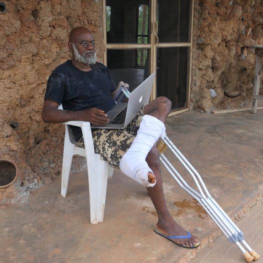 a picture of moyo okediji with a precast on his leg after a minor accident at the akodi orisa